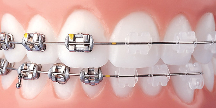 Orthodontic Treatment  Nokta Ağız ve Diş Sağlığı Polikliniği